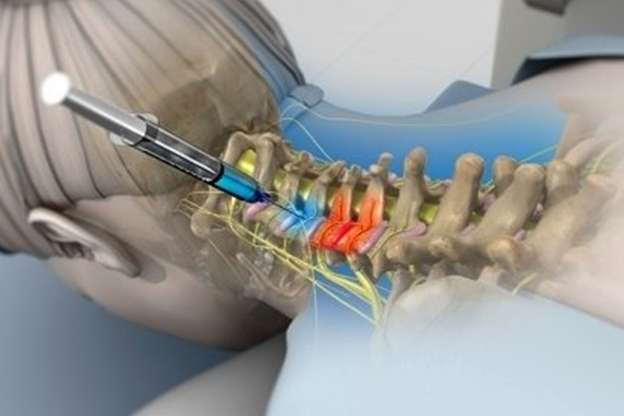 Epidural Blood Patch
