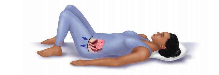 Pelvic Floor Muscle Exercises