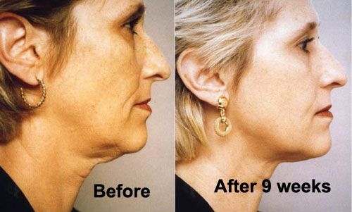 Workouts for Neck Skin Tightening