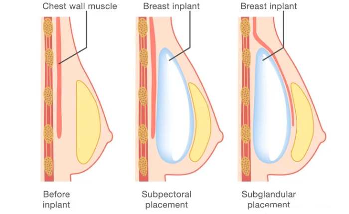 type of breast surgery