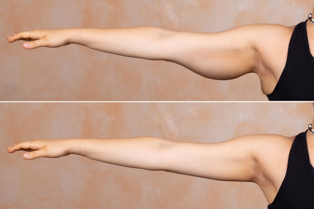 How To Make Your Arms Thinner Without Exercise?