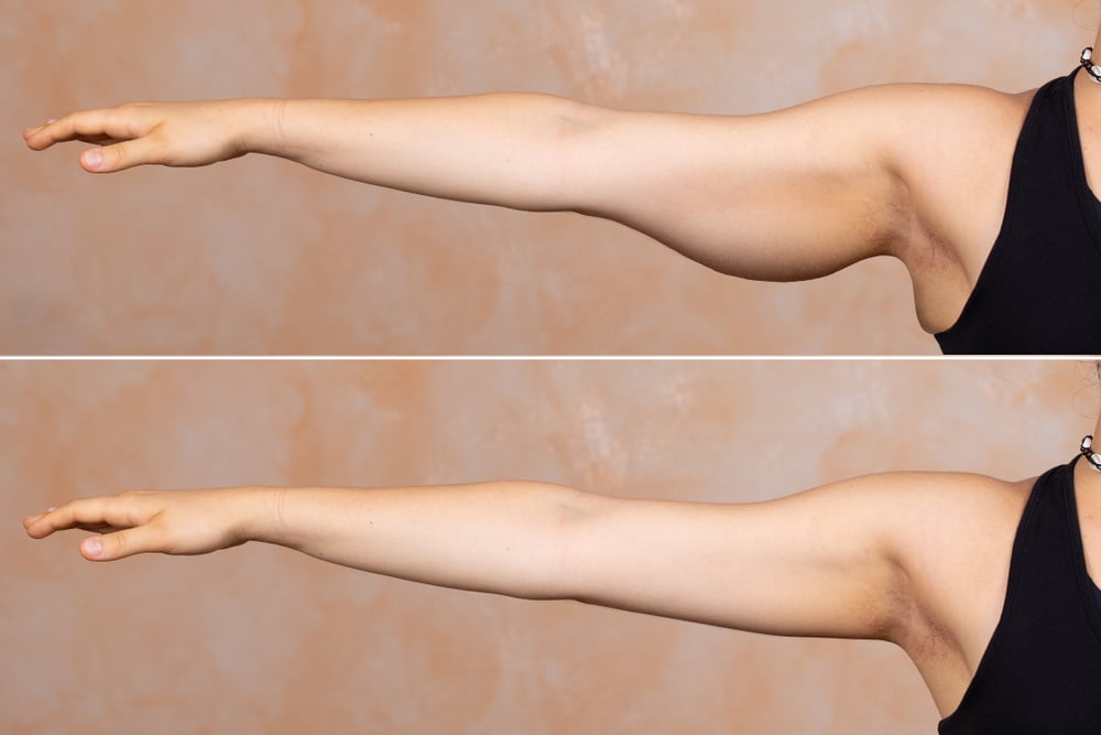Exercises to make your arms thinner deals